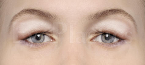 Cosmetic eyelid surgery, Blepharoplasty, Eyelift Cosmetic eyelid surgery, Blepharoplasty, Eyelift